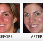 symptoms of rosacea