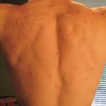how to stop workout acne