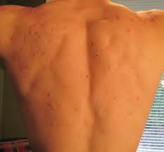 how to stop workout acne