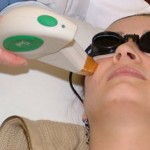 LaserAcneRemoval