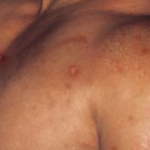 body acne