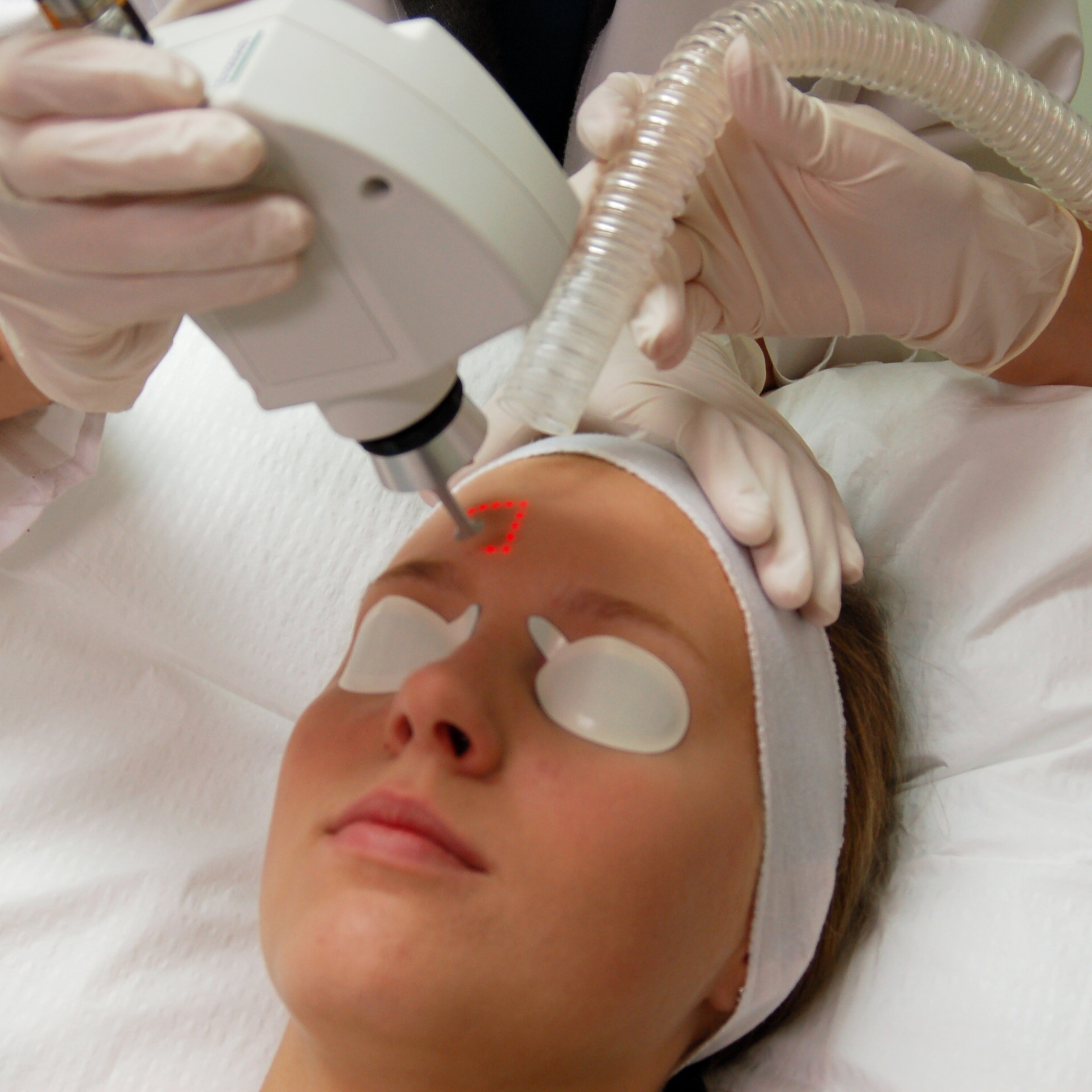 Laser treatment for acne and scars