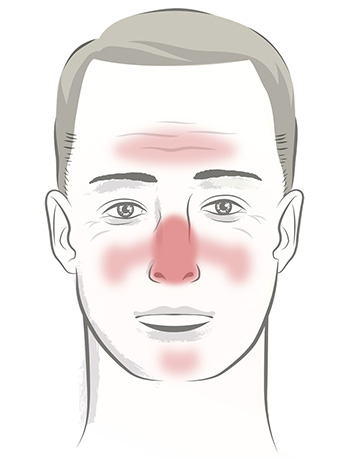 face_of_rosacea_male