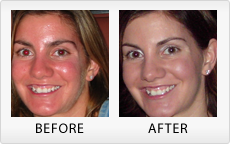 Banishing the Symptoms of Rosacea - Skincare Tips Blog by ZENMED
