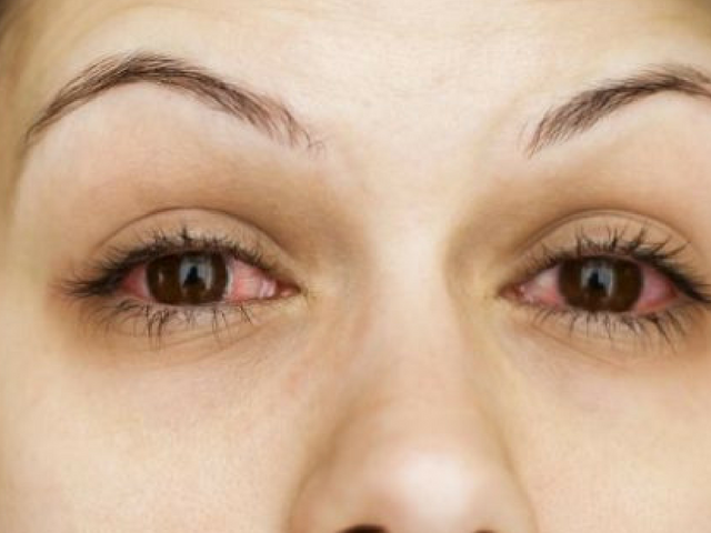 Bloodshot eyes? Why it could be Ocular Rosacea